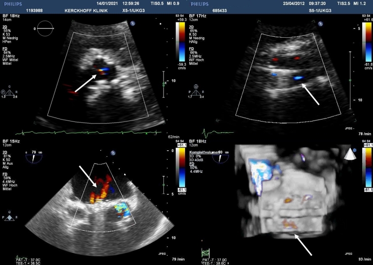 Prosthetic heart valves Part 3 Imaging
